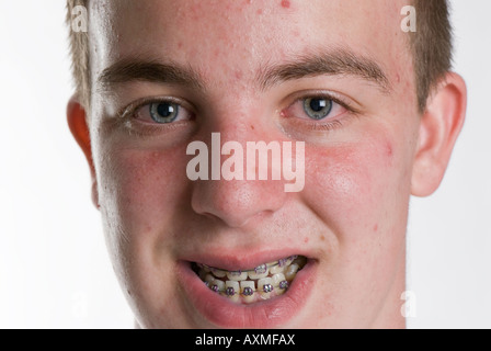 Teenager mit Akne und Hosenträger Stockfoto