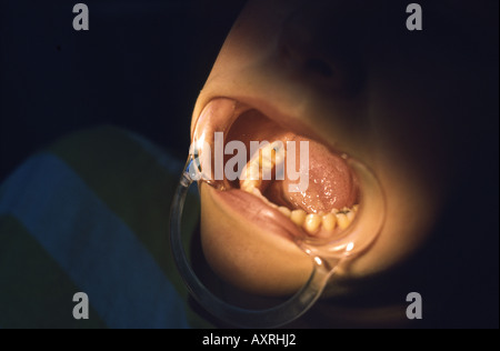 Zähne werden in den Zahnarztstuhl verspannt Stockfoto