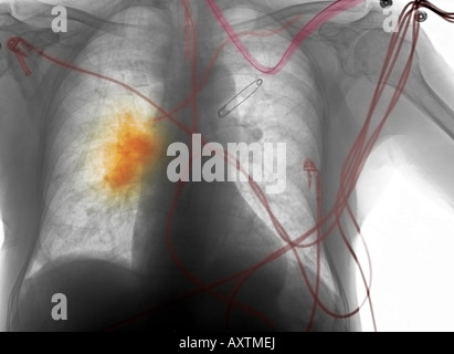 Röntgen-Thorax der ein 80 Jahre alter Mann mit einem langen Rauchgewohnheiten, der Krebs entwickelt Stockfoto