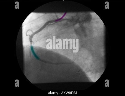 Digital erweitert, eingefärbte Röntgenaufnahme einer koronaren Angiogramm zeigt einen Stent, Stenose der rechten Koronararterie zu korrigieren Stockfoto