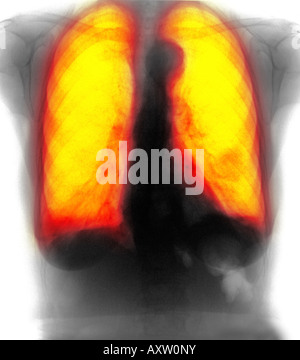 Röntgen-Thorax zeigt COPD (chronisch obstruktive Lungenerkrankung) und doppelseitige Lungenentzündung in einer 76 Jahre alten Frau links Stockfoto