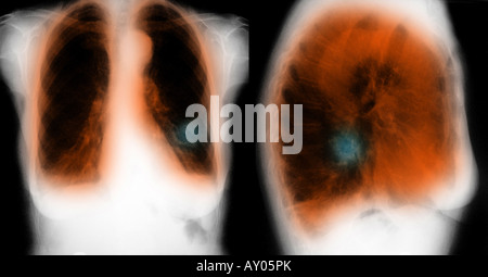 Röntgen-Thorax zeigt COPD (chronisch obstruktive Lungenerkrankung) und doppelseitige Lungenentzündung in einer 76 Jahre alten Frau links Stockfoto