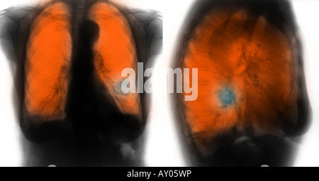 Brust Röntgen Shwoing COPD (chronisch obstruktive Lungenerkrankung) und doppelseitige Lungenentzündung in einer 76 Jahre alten Frau links Stockfoto