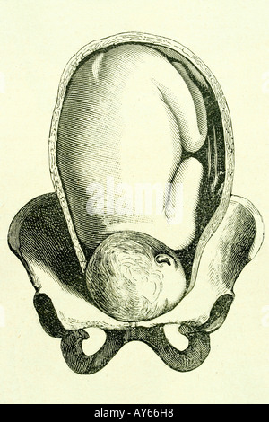 Anomale Position des Fötus. Antike Darstellung. Medizin-Buch. 1889. Stockfoto