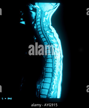 MRI scan der Wirbelsäule zurück Stockfoto