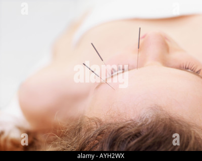 Frau empfangen Akupunktur Stockfoto