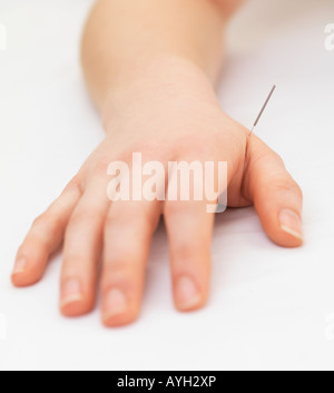 Frau empfangen Akupunktur Stockfoto