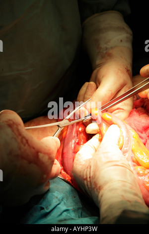 Chirurgen weggeschnitten krebsartigen Teil des Dickdarms während des Betriebs, Abschnitt und Restitch entfernen Stockfoto