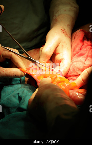 Chirurgen weggeschnitten krebsartigen Teil des Dickdarms mit Kelly Instrument während des Betriebs zu Abschnitt und Restitch entfernen Stockfoto