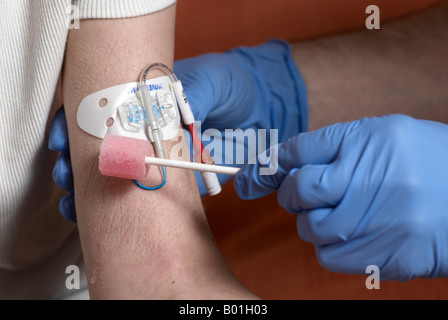 Reinigung einer Picc Linie mit einem Tupfer (peripher zentrale Katheter) Stockfoto