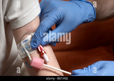 Reinigung einer Picc Linie mit einem Tupfer (peripher zentrale Katheter) Stockfoto