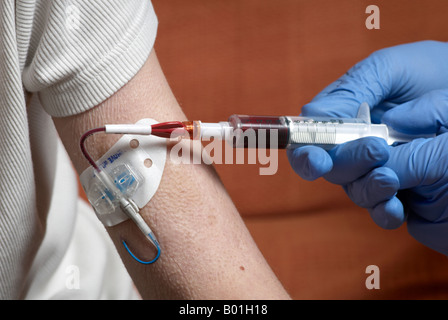 Blutentnahme aus einer Picc Linie mit OP-Handschuhen (peripher zentrale Katheter) Stockfoto