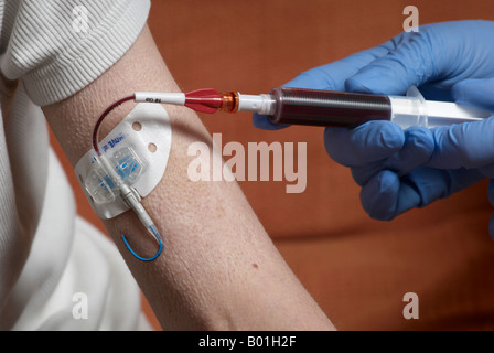 Blutentnahme aus einer Picc Linie mit OP-Handschuhen (peripher zentrale Katheter) Stockfoto