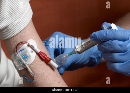 Mit Hilfe einer Spritze zum sterilen Salzwasser Rücktritt einer abscheulichen (peripher zentrale Katheter) Stockfoto