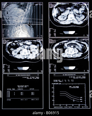 medizinische Scan-to-Krankheit im Darm oder Knochen zeigen Stockfoto