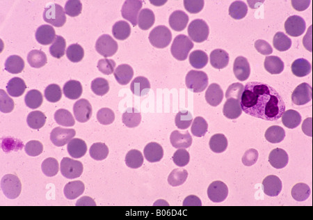 Rote Blutkörperchen mit spherocytosis Stockfoto