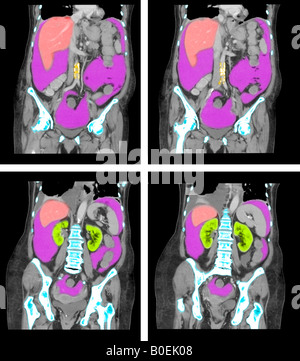 CT des Abdomen und Becken der 77 Jahre alte Frau mit Krebs Stockfoto