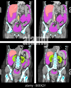 CT des Abdomen und Becken der 77 Jahre alte Frau mit Krebs Stockfoto