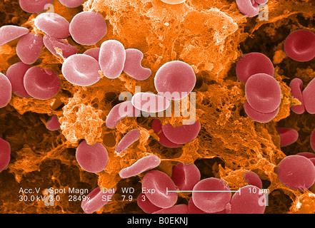 eingefärbte Rasterelektronenmikroskop Bild eines Blutgerinnsels Stockfoto