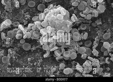Rasterelektronenmikroskop Bild eines Blutgerinnsels mit roten Blutkörperchen und Fibrin Koagulum Stockfoto
