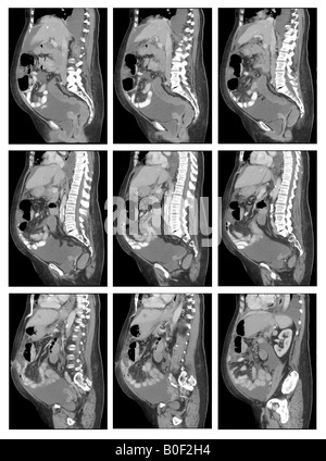 CT des Abdomen und Becken der 77 Jahre alte Frau mit Krebs Stockfoto