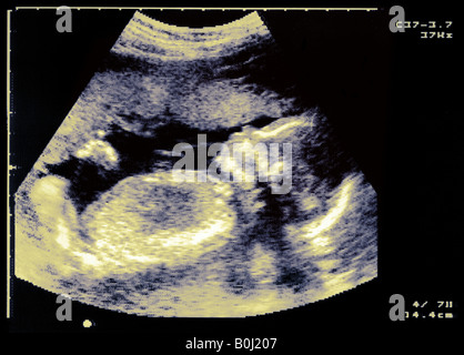 ULTRASCHALL BILD SCAN FÖTUS Stockfoto
