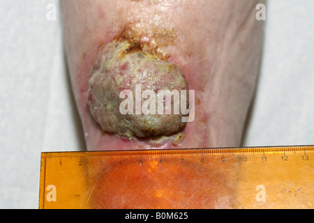 Ein 5cm malignen Plattenepithelkarzinom (Hautkrebs) am Unterschenkel einer älteren Frau Stockfoto