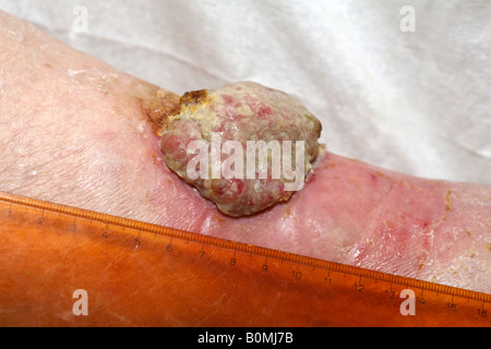 Ein 5cm malignen Plattenepithelkarzinom (Hautkrebs) am Unterschenkel einer älteren Frau Stockfoto