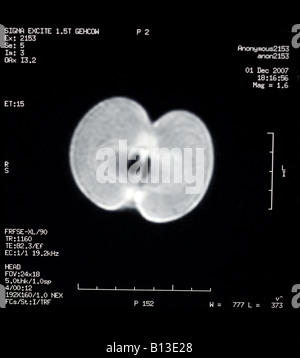 MRI des Apfels Stockfoto