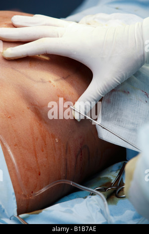 Der Fettabbau Chirurgie Chirurg Stockfoto