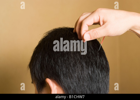 Arzt Akupunkturnadeln am Kopf des Patienten zu setzen Stockfoto