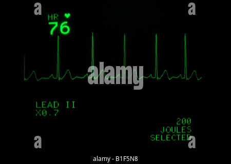 EKG monitor Anzeige der Herzfrequenz Stockfoto