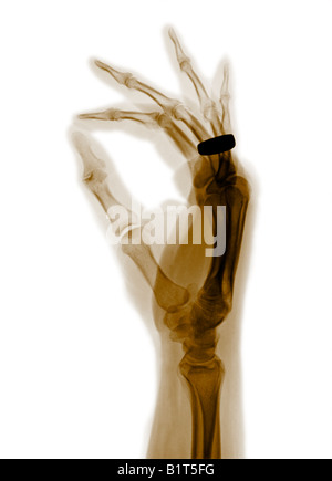 X-ray 68 Jahre alten Mannes hand Stockfoto