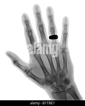 X-ray 68 Jahre alten Mannes hand Stockfoto