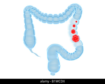 Darmkrebs Stockfoto