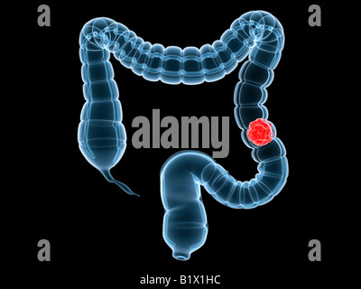 Darmkrebs Stockfoto