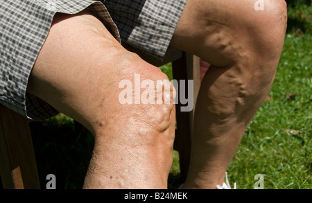 Stock Foto von einem siebzig Jahre alten Womans Beine, was das Bild zeigt die Krampfadern an den Beinen Stockfoto