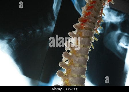 Fotografieren Sie mit Röntgen der Wirbelsäule mit Modell der Wirbelsäule im Vordergrund Stockfoto