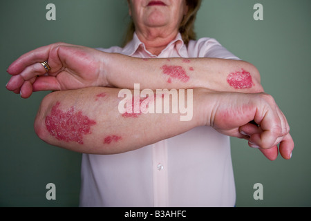 Psoriasis an Unterarmen und Psoriasis-Arthropathie in Händen einer Frau 60 Jahre alt Stockfoto