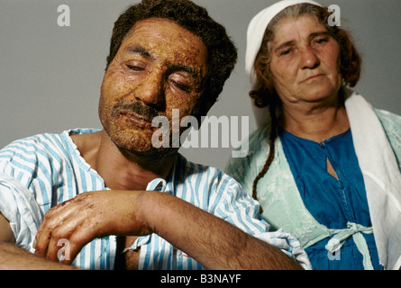 KURDISTAN ", SHAMEL ALI LIEGT IN ZAKHO HOSPITAL VON NAPALM SANK UM TÜRKISCHE FLUGZEUGE AUF BEGOVA DORF VERBRANNT Stockfoto
