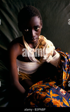 BURUNDIS ETHNISCHE KONFLIKTE ", NOVEMBER 1993.  TUTSI-BOY IM KIRUNDO KRANKENHAUS DREI MACHETE WUNDEN LEIDEN Stockfoto