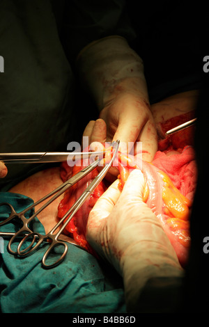 Chirurgen clipping Doppelpunkt mit Kelly chirurgischen Instrument krebsartigen Abschnitt und Restitch entfernen Stockfoto
