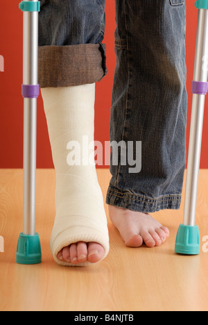 Bein in Gips Stockfoto, Bild: 225369419 - Alamy Bein in Gips Stockfoto, Bild: 225369419 - Alamy