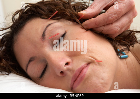 Akupunkturnadeln auf das Gesicht einer erwachsenen Frau Ende der zwanziger Jahre angewendet wird Stockfoto