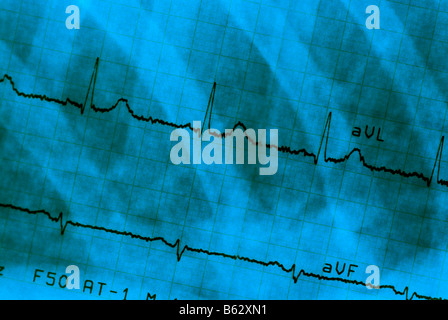 Nahaufnahme eines Elektrokardiogramm-Berichts Stockfoto