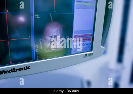 Computer generierte Bild des Patienten, von Neurochirurgen verwendet, um Hilfe bei der Entfernung von gutartigen Gehirntumor, Reykjavik, Island Stockfoto