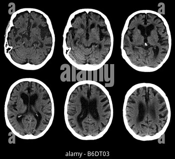 Alzheimer-Krankheit. Serie von Computertomographie (CT) Scans einer axialen Abschnitt durch den Kopf eines 74 Jahre alten Patienten. Stockfoto