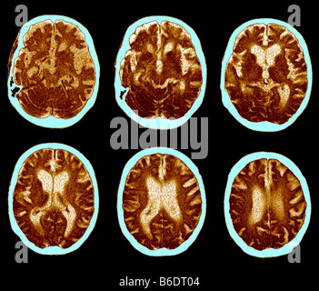 Alzheimer-Krankheit. Serie von Computertomographie (CT) Scans einer axialen Abschnitt durch den Kopf eines 74 Jahre alten Patienten. Stockfoto