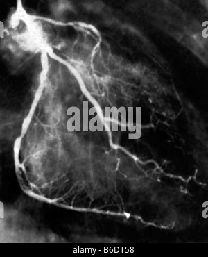 Verengte Herzkranzgefäße. Koronaren Angiographie (Röntgen) eines 59 Jahre alten Patienten. Stockfoto