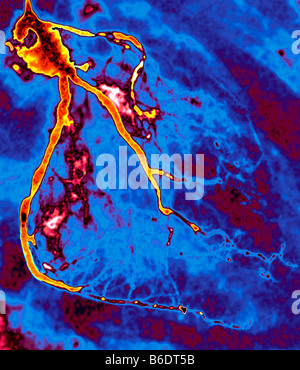 Verengte Herzkranzgefäße. Farbige Coronaryangiogram (Röntgen) eines 59 Jahre alten Patienten. Stockfoto